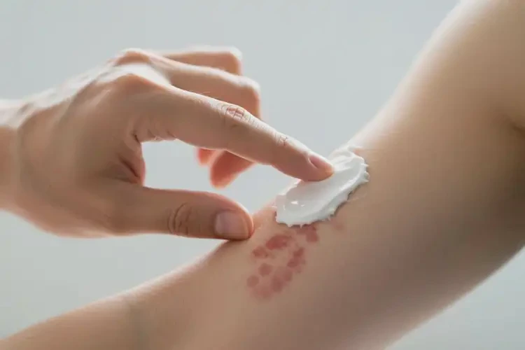 男生手臂出濕疹可不可以根治(圖3)