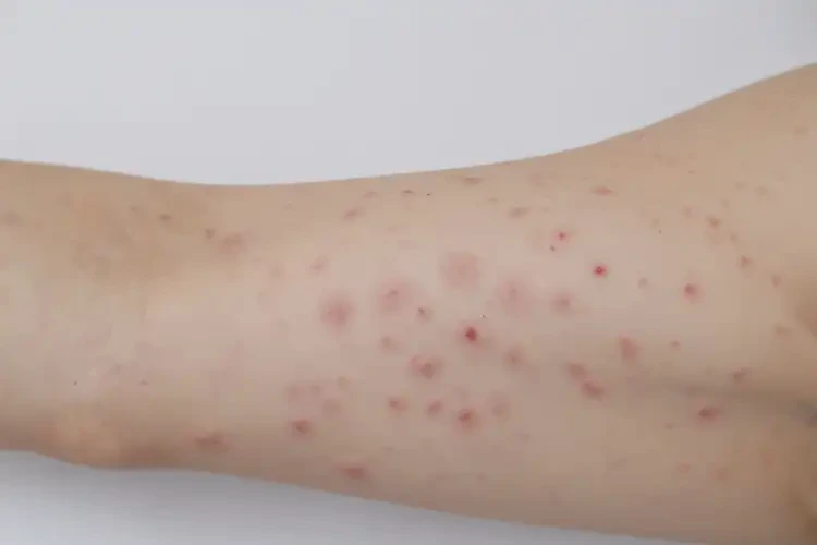 女生手臂上有濕疹可以徹底自愈嗎(圖2)