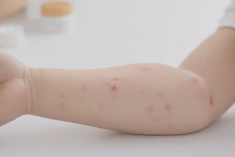 少兒手臂上偶爾長(zhǎng)濕疹能徹底自愈嗎(圖3)