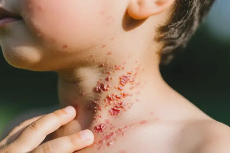 孩子脖子上偶爾起濕疹可不可以根治(圖2)