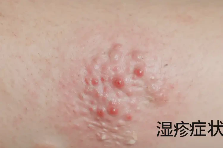 女人手臂上偶尔长湿疹能不能根治(图3)