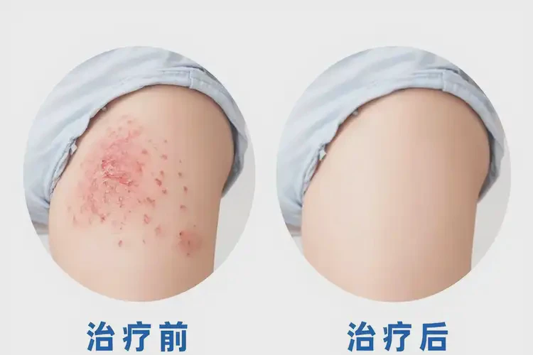 少兒屁股上有濕疹可不可以根治(圖4)