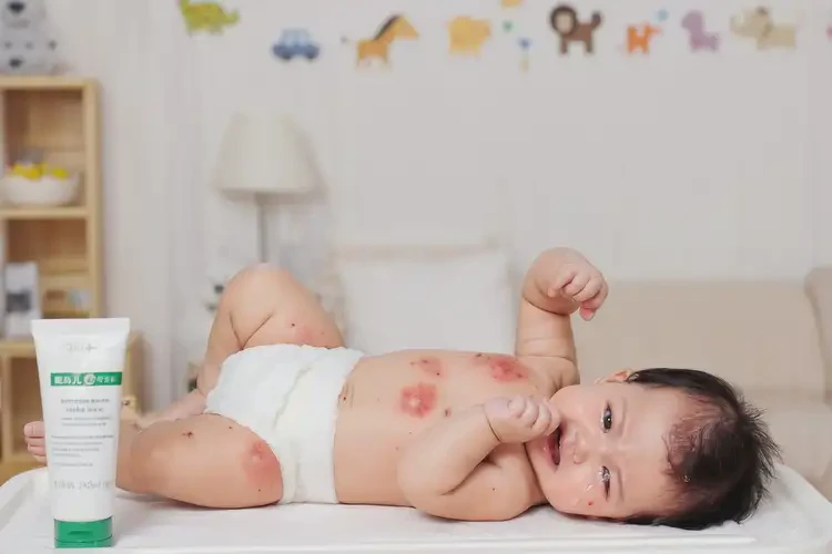 嬰幼兒肛周長(zhǎng)濕疹可不可以根治(圖4)