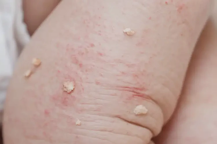 嬰幼兒大腿出濕疹不管它會(huì)自己痊愈嗎(圖4)