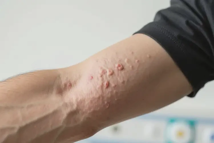 男人手臂上起湿疹能不能根治(图4)