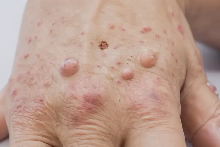 女性手上出濕疹可以徹底自愈嗎(圖4)