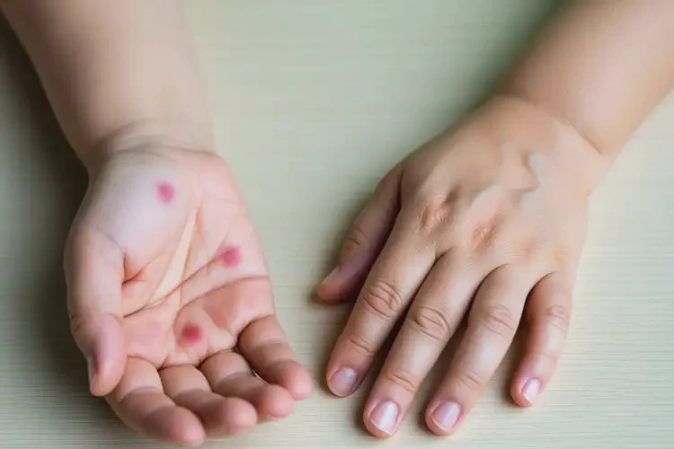產(chǎn)婦手上偶爾長(zhǎng)濕疹可不可以根治(圖3)