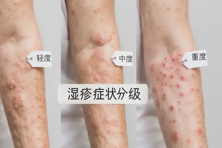 女人身上出濕疹能不能徹底自愈(圖4)