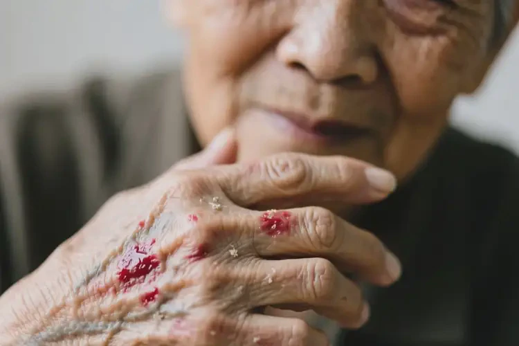 老人身上容易起濕疹不管它會自己自愈嗎(圖3)