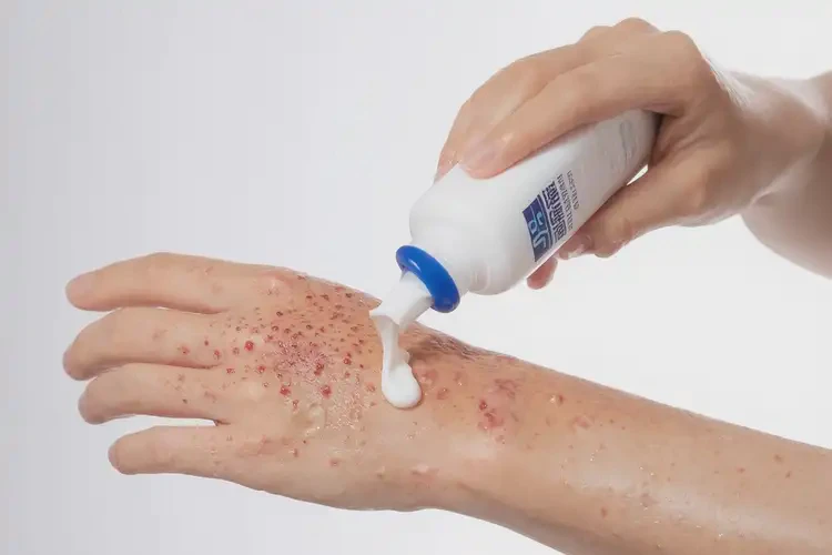 女性手上出濕疹可以徹底自愈嗎(圖3)