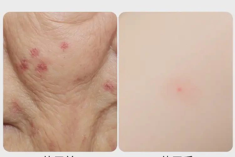 老人面部經(jīng)常起濕疹可不可以根治(圖2)