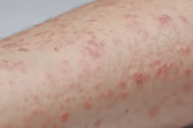 中學(xué)生手臂上容易長濕疹能靠自己自愈嗎(圖4)