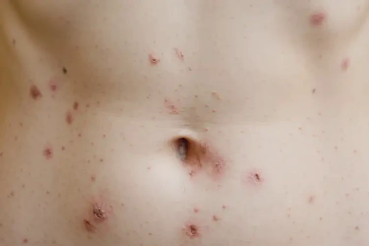 女人肚子上經(jīng)常長(zhǎng)濕疹能不能根治(圖4)