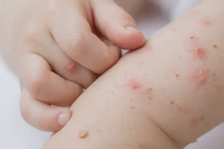 幼儿手上容易长湿疹不管它会自己自愈吗(图4)