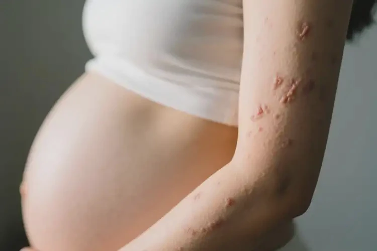 孕婦手臂上經(jīng)常起濕疹不管它會(huì)自己好嗎(圖4)