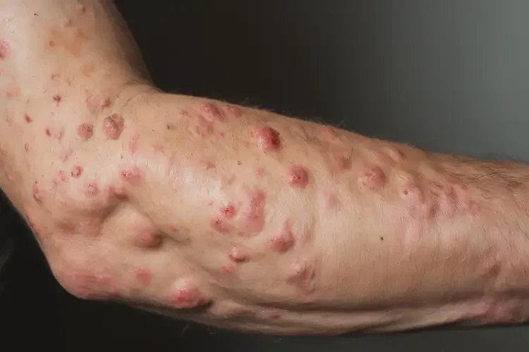 男人手臂上偶爾起濕疹能不能根治(圖4)