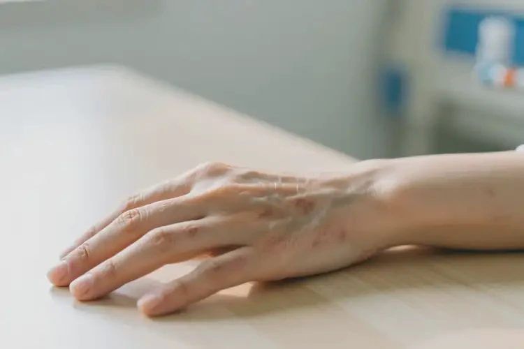 女人手上有濕疹能不能根治(圖4)