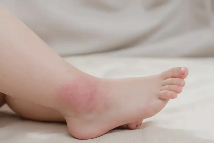 少兒腳上偶爾長濕疹不管它會(huì)自己自愈嗎(圖3)