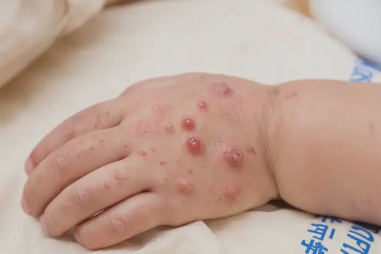 幼儿手上容易长湿疹不管它会自己自愈吗(图3)