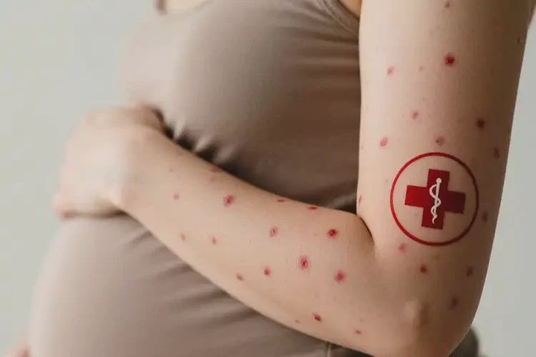 產(chǎn)婦手臂偶爾起濕疹可不可以根治(圖1)