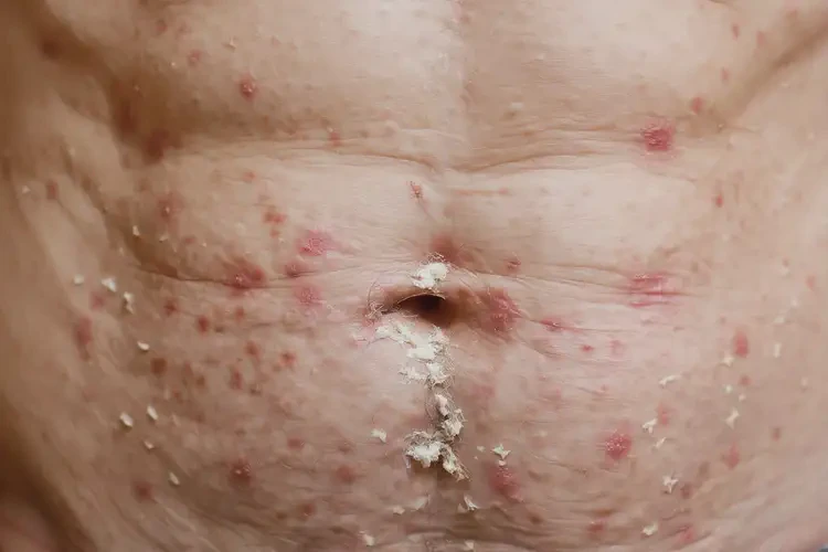 高齡老人肚子長濕疹能不能根治(圖4)