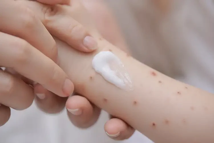 嬰兒手臂上容易長濕疹可不可以根治(圖3)