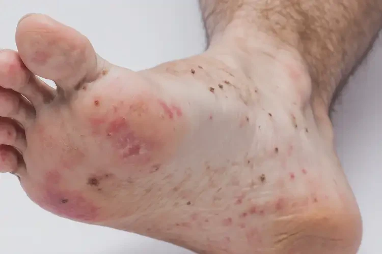 男生腳上偶爾長濕疹能夠徹底治愈嗎(圖4)