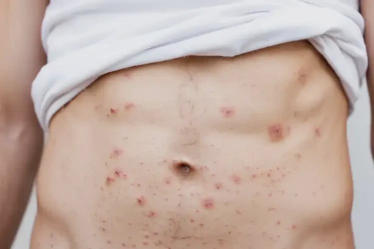 青少年肚子上出濕疹可不可以徹底自愈(圖4)