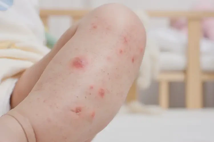 寶寶小腿上長濕疹可不可以根治(圖4)