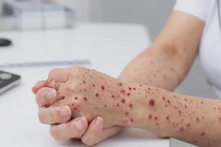 女人身上偶爾長濕疹能不能徹底自愈(圖3)