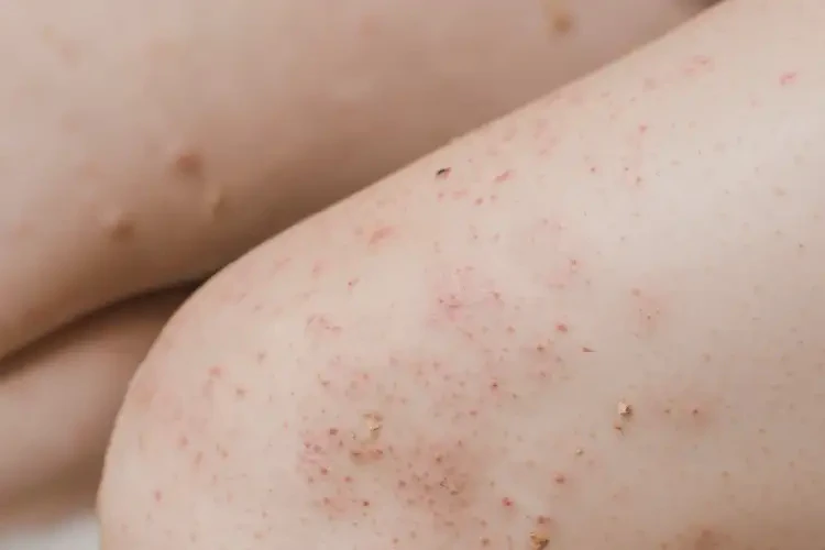 女人四肢出濕疹可不可以徹底自愈(圖3)