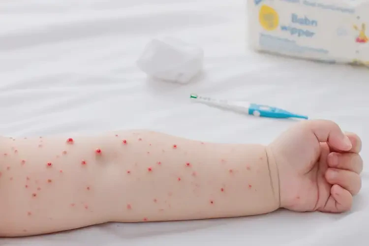 幼兒屁股上經(jīng)常長(zhǎng)濕疹可不可以根治(圖4)