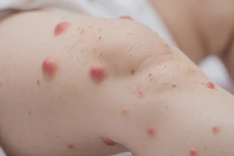 新生兒大腿經(jīng)常起濕疹不管它會(huì)自己痊愈嗎(圖4)