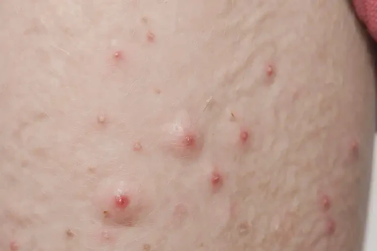 男人小腿有濕疹能不能根治(圖4)