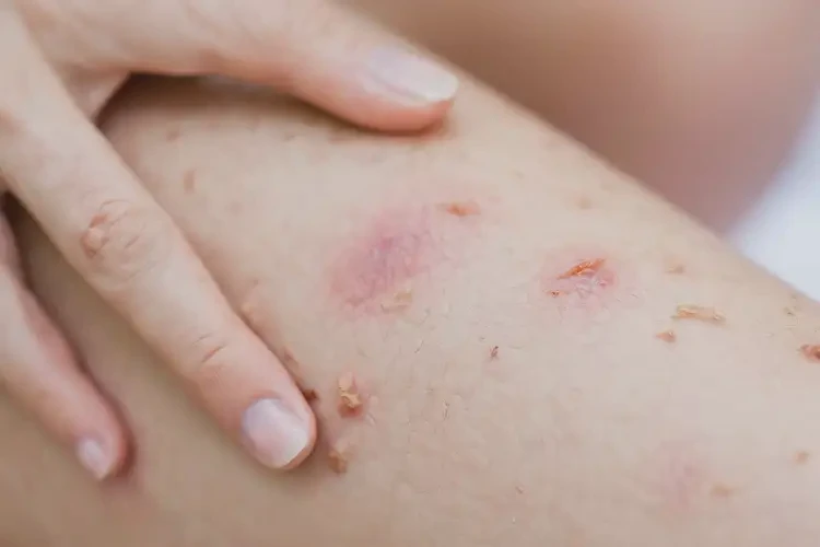 產(chǎn)婦小腿上出濕疹可不可以根治(圖4)