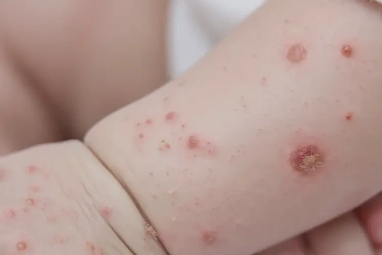 嬰兒手臂上容易長濕疹可不可以根治(圖4)