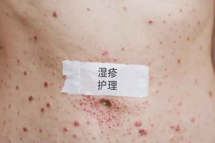 女人肚子偶爾長濕疹能不能根治(圖4)