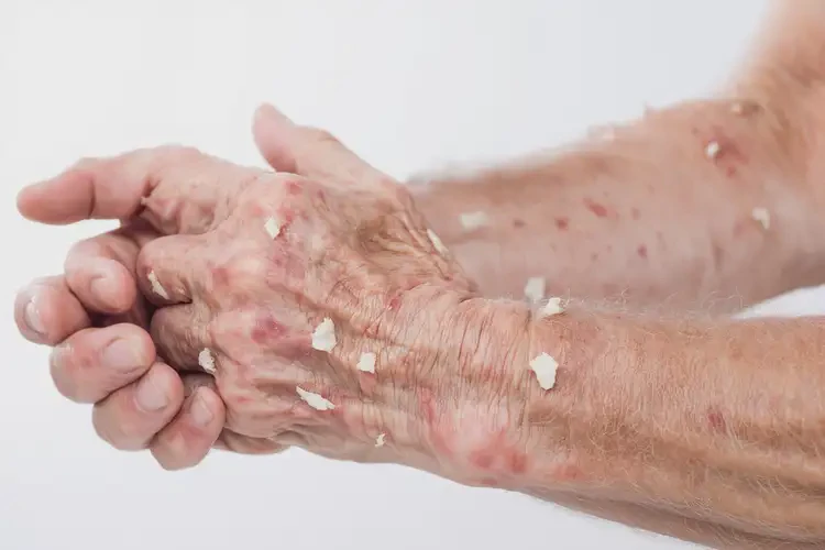 高齡老人手臂上經(jīng)常起濕疹能不能根治(圖2)