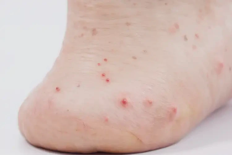 女人腳上偶爾起濕疹能不能根治(圖4)