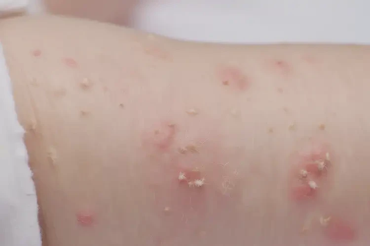 寶寶手臂上出現(xiàn)濕疹能靠自己自愈嗎(圖4)