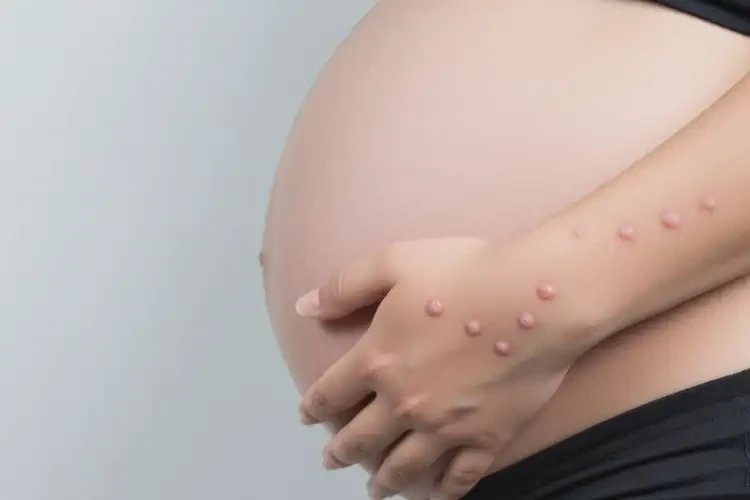 孕婦手上偶爾起濕疹可不可以根治(圖2)