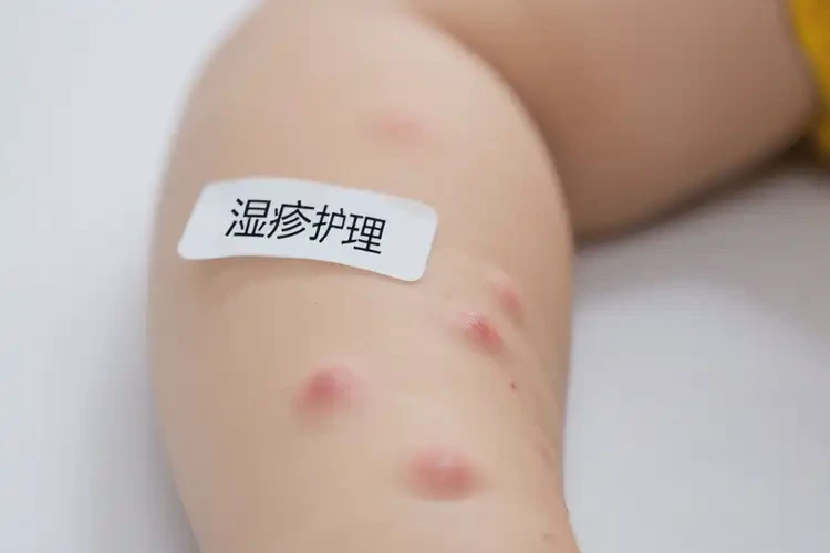 小孩手臂上起濕疹可以徹底自愈嗎(圖4)