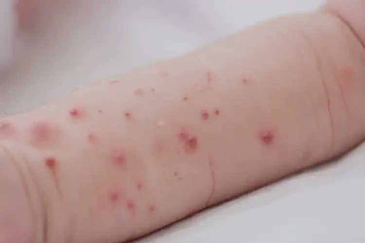 新生兒手臂出濕疹能靠自己自愈嗎(圖4)