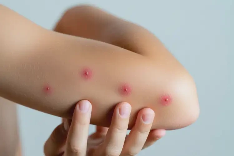 孩子手臂上起湿疹可不可以根治(图1)
