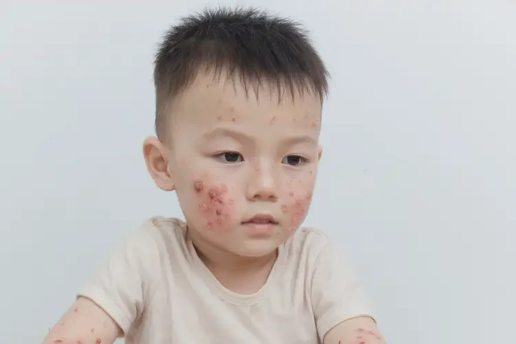 幼兒肛周出濕疹可不可以根治(圖3)