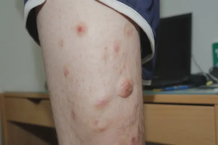 大學(xué)生大腿上有濕疹能徹底自愈嗎(圖2)