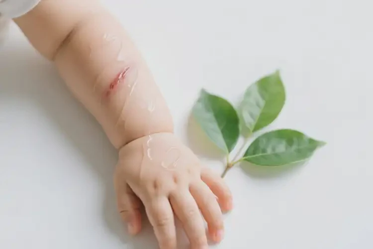 幼兒手臂出濕疹可不可以根治(圖3)