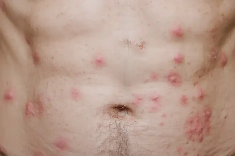 高齡老人肚子偶爾長濕疹能不能根治(圖4)