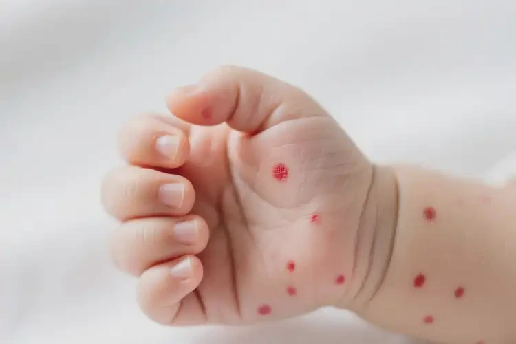 嬰兒手上出現(xiàn)濕疹不管它會(huì)自己自愈嗎(圖4)