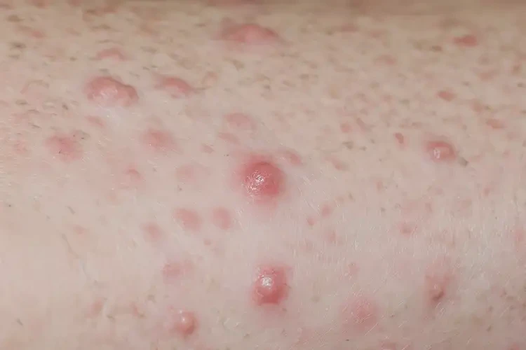 男人四肢偶爾起濕疹能不能根治(圖4)